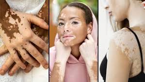 Skin pigmentation disorder