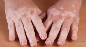 Skin pigmentation disorder: শ্বেতী কোনো অভিশাপ নয়, বরং ত্বকের অসুখ: কেন হয় এবং কীভাবে ঠেকাবেন এর বিস্তার? 3 Skin pigmentation disorder
