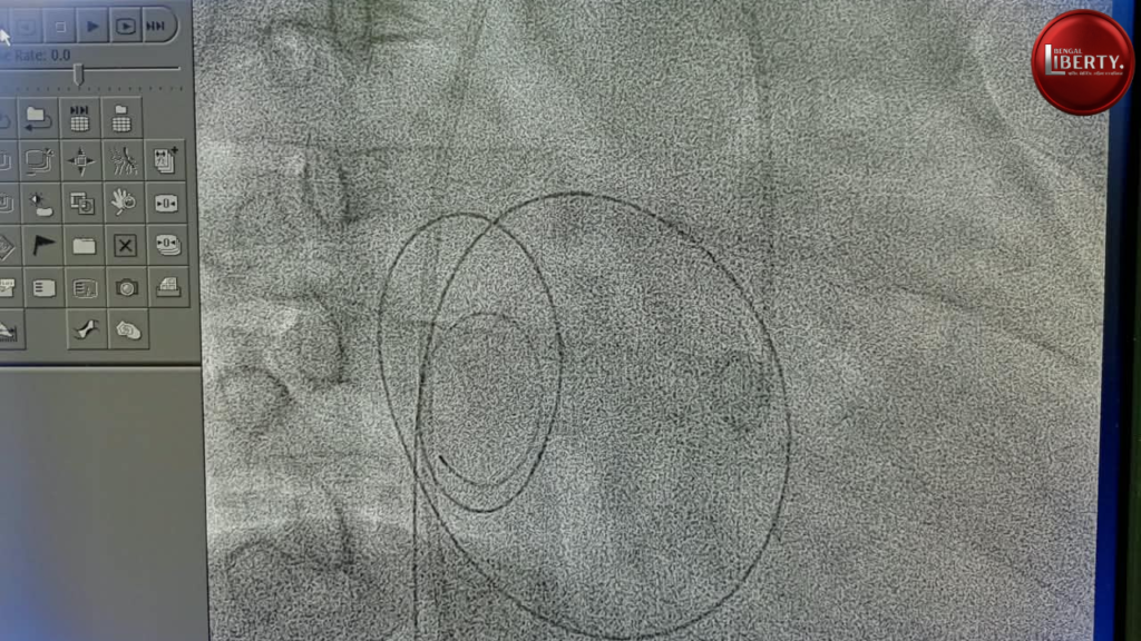 Heart Operation
